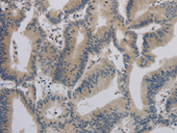 ACVR1B