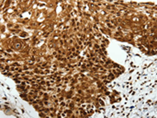 SCN1A