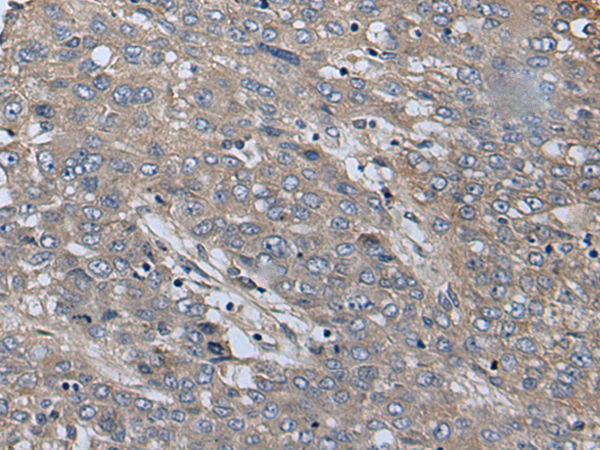 SLC39A14