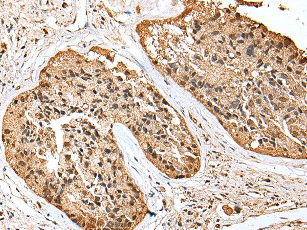 SCN1A