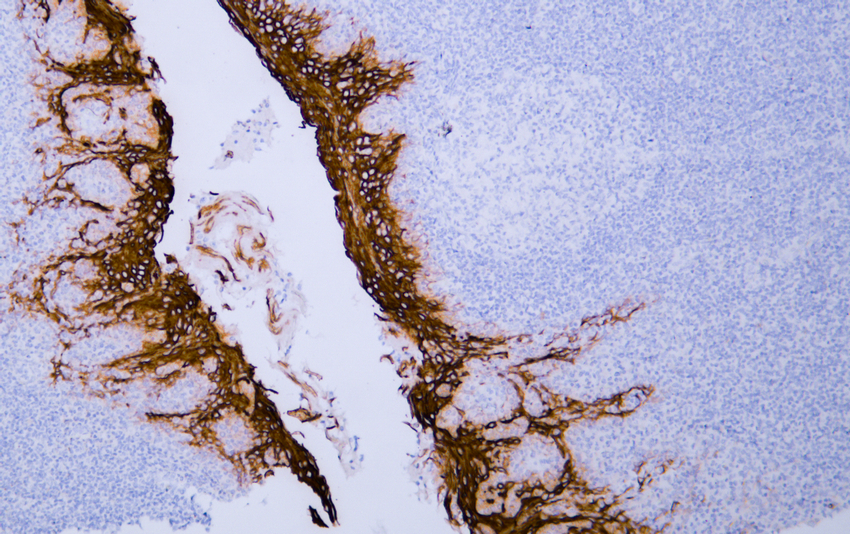 Cytokeratin 6 
