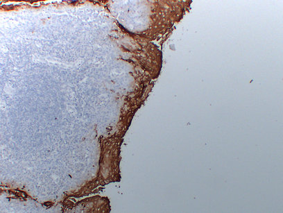carcinoembryonic antigen 
