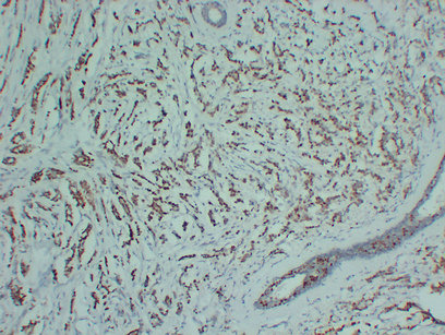 Progesterone Receptor 