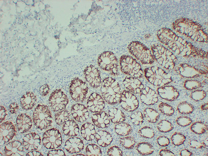 TGF β Receptor I 