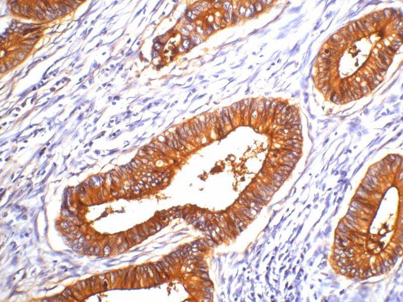 Carcinoembryonic Antigen(CEA) 