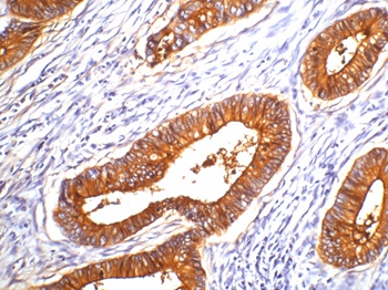 Carcinoembryonic Antigen