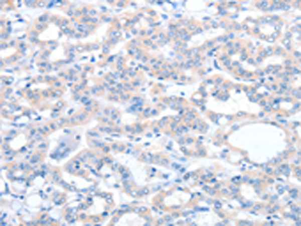 The image is immunohistochemistry of paraffin-embedded Human thyroid ...
