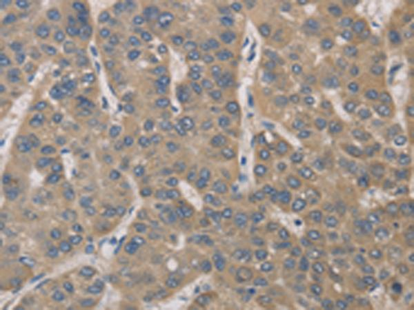 IRAK4抗体临床诊断用途